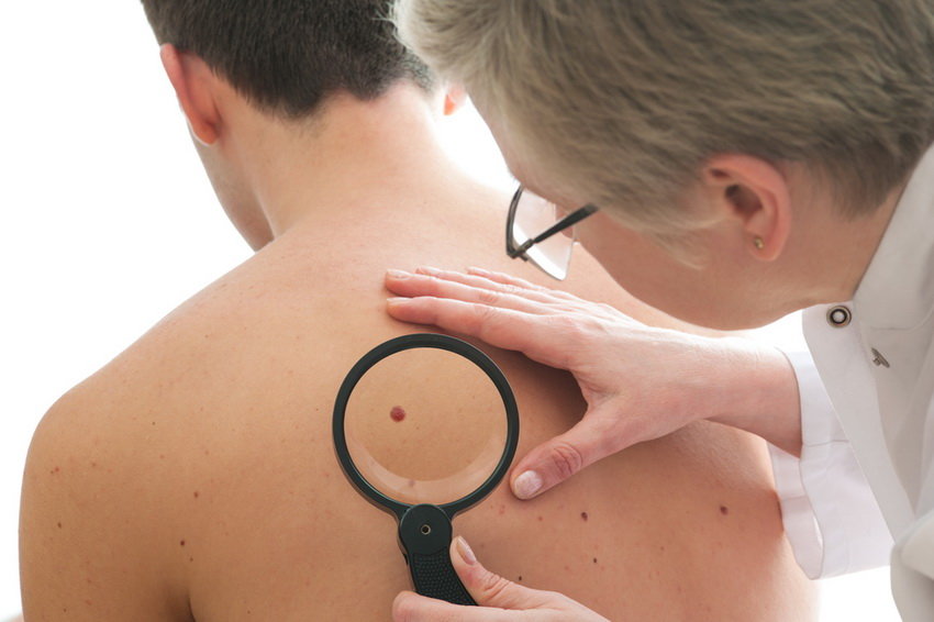 25696 Мужчины оказались склонны к раку кожи - исследование