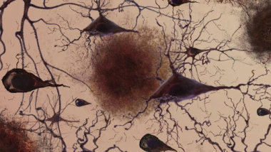 26651 Обнаружена связь между апноэ во сне и болезнью Альцгеймера