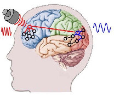 27377 Воздействие сфокусированным ультразвуком на мозг перспективно для лечения болезни Паркинсона